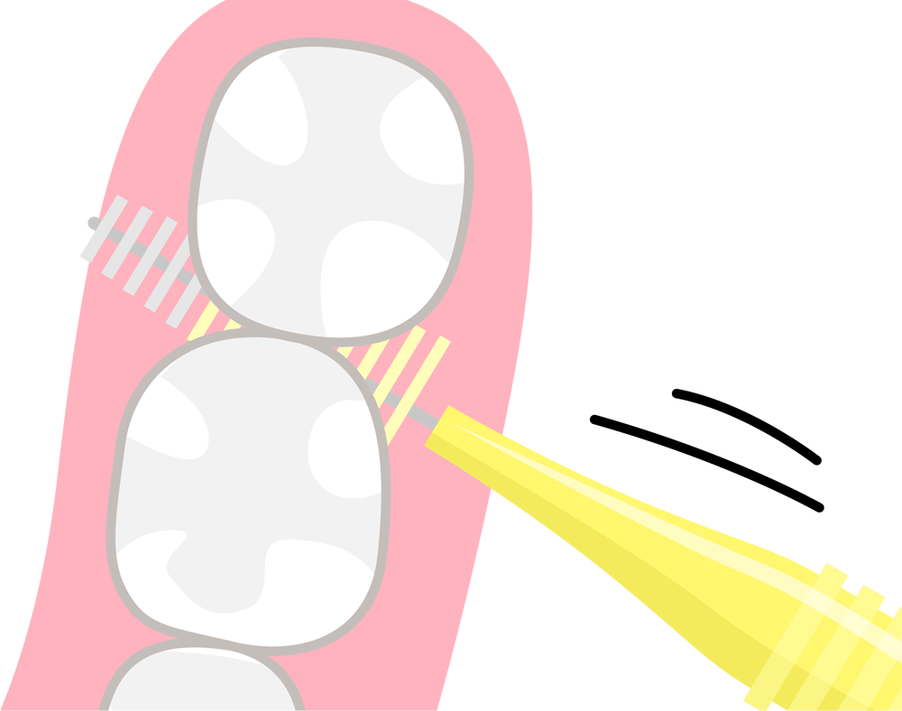 歯間部のケア(フロス・歯間ブラシ)